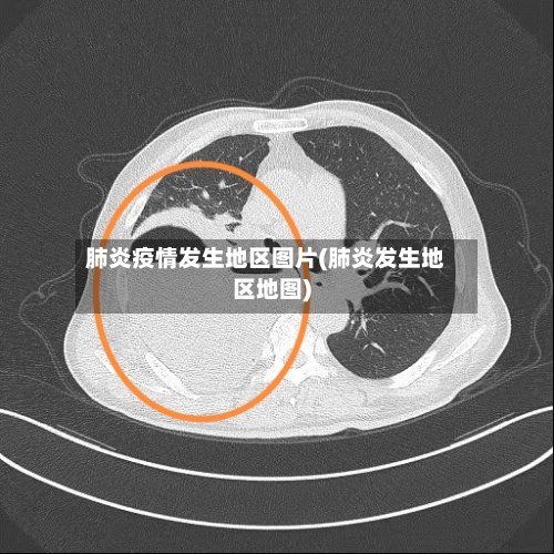 肺炎疫情发生地区图片(肺炎发生地区地图)-第2张图片