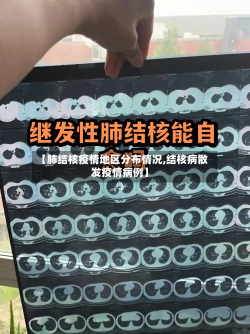 【肺结核疫情地区分布情况,结核病散发疫情病例】